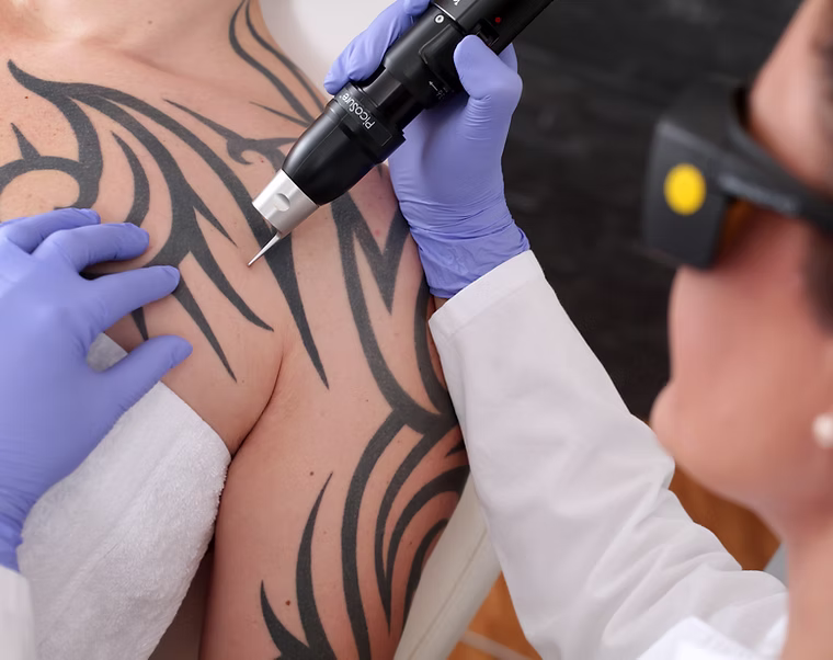 Tattoo Removal