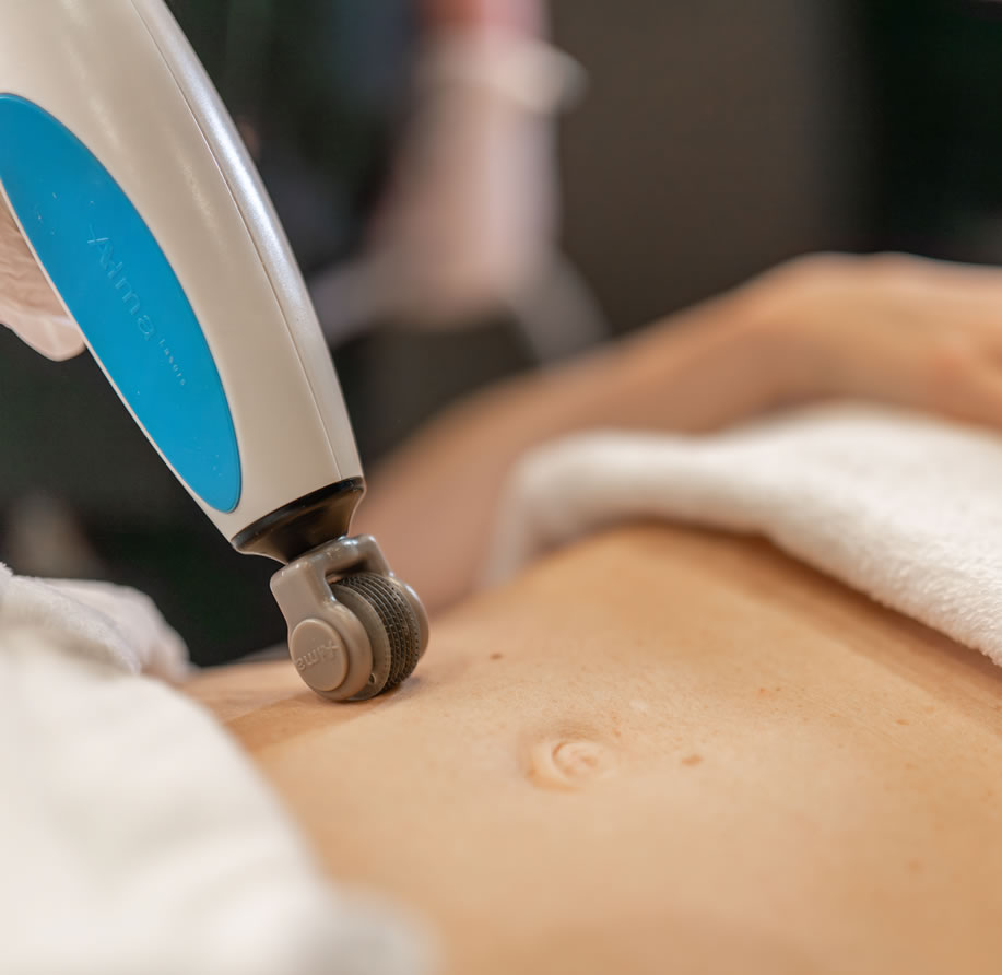 Microneedling Microneedling